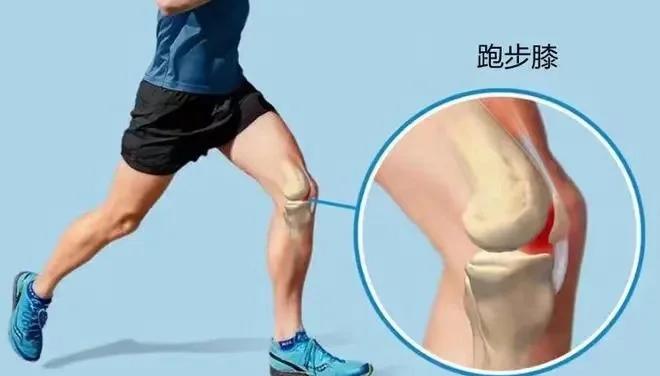 跑步膝预防全攻略：选鞋训练有讲究的简单介绍